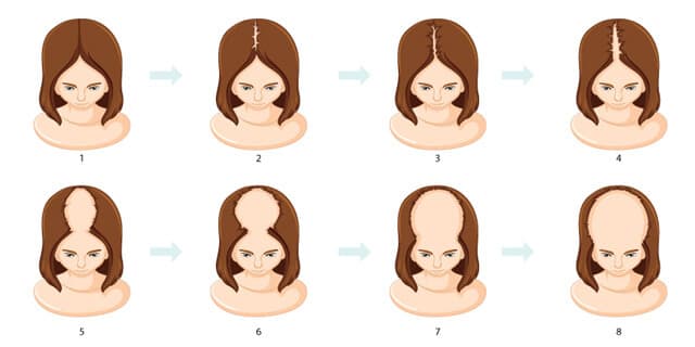 female-pattern-hair-loss.jpg